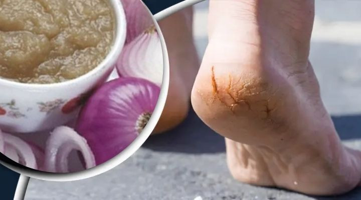 পা ফাটা রোধে পেঁয়াজের ব্যবহার